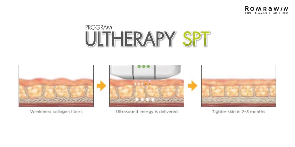 How to ultherapy