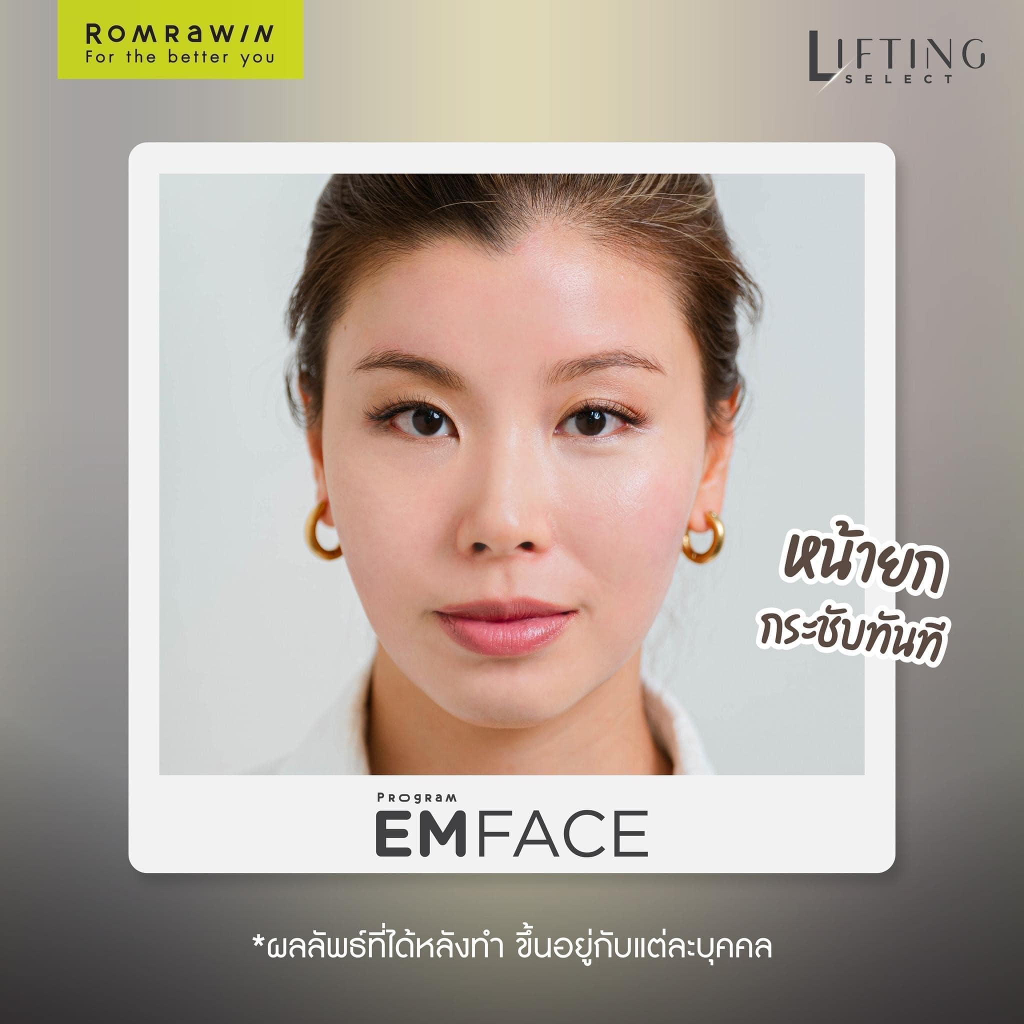 emface ยกกระชับใบหน้าทันทีหลังทำ