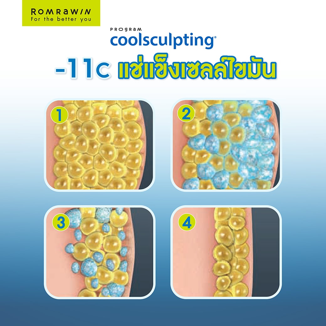 CoolSculpting