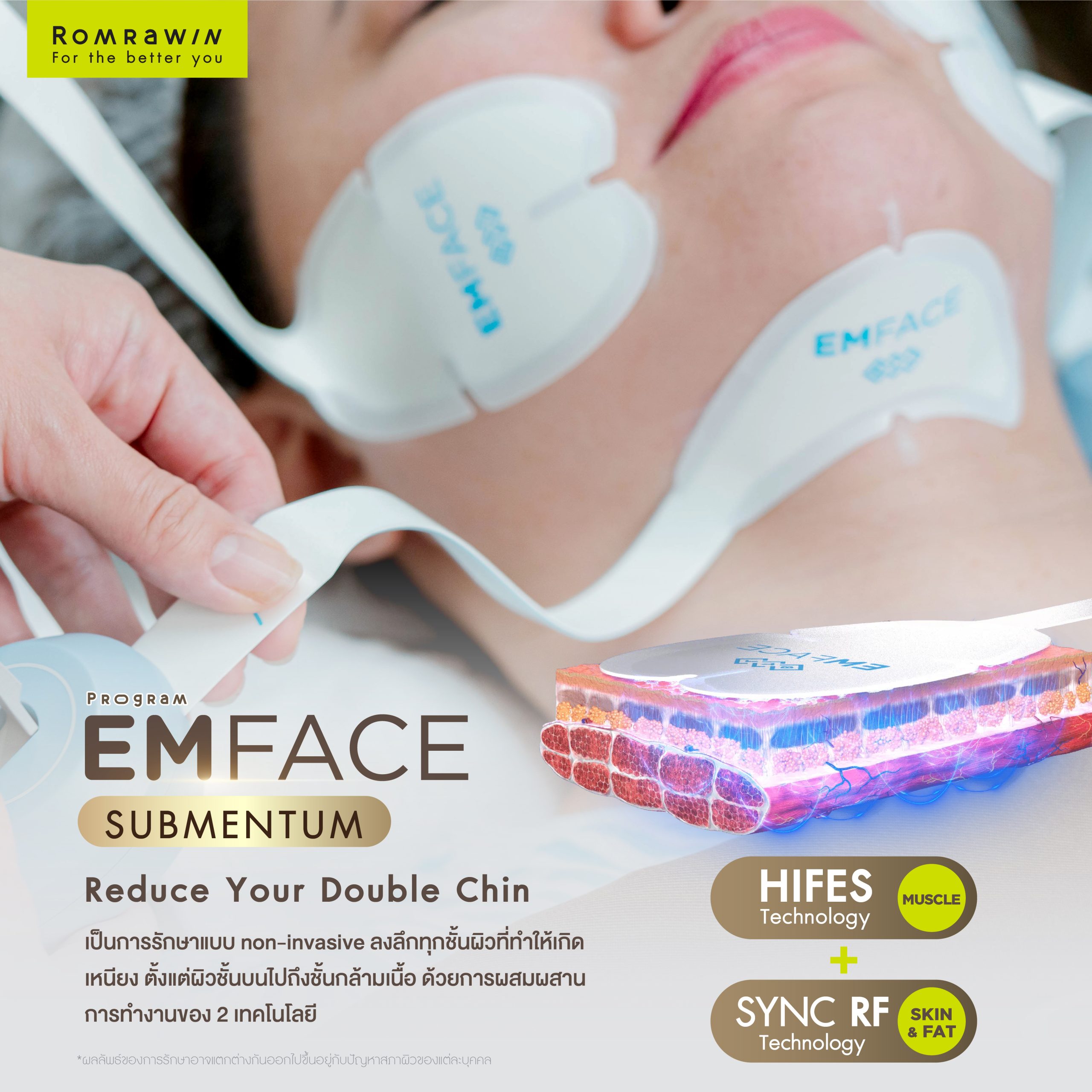 Emface submentum