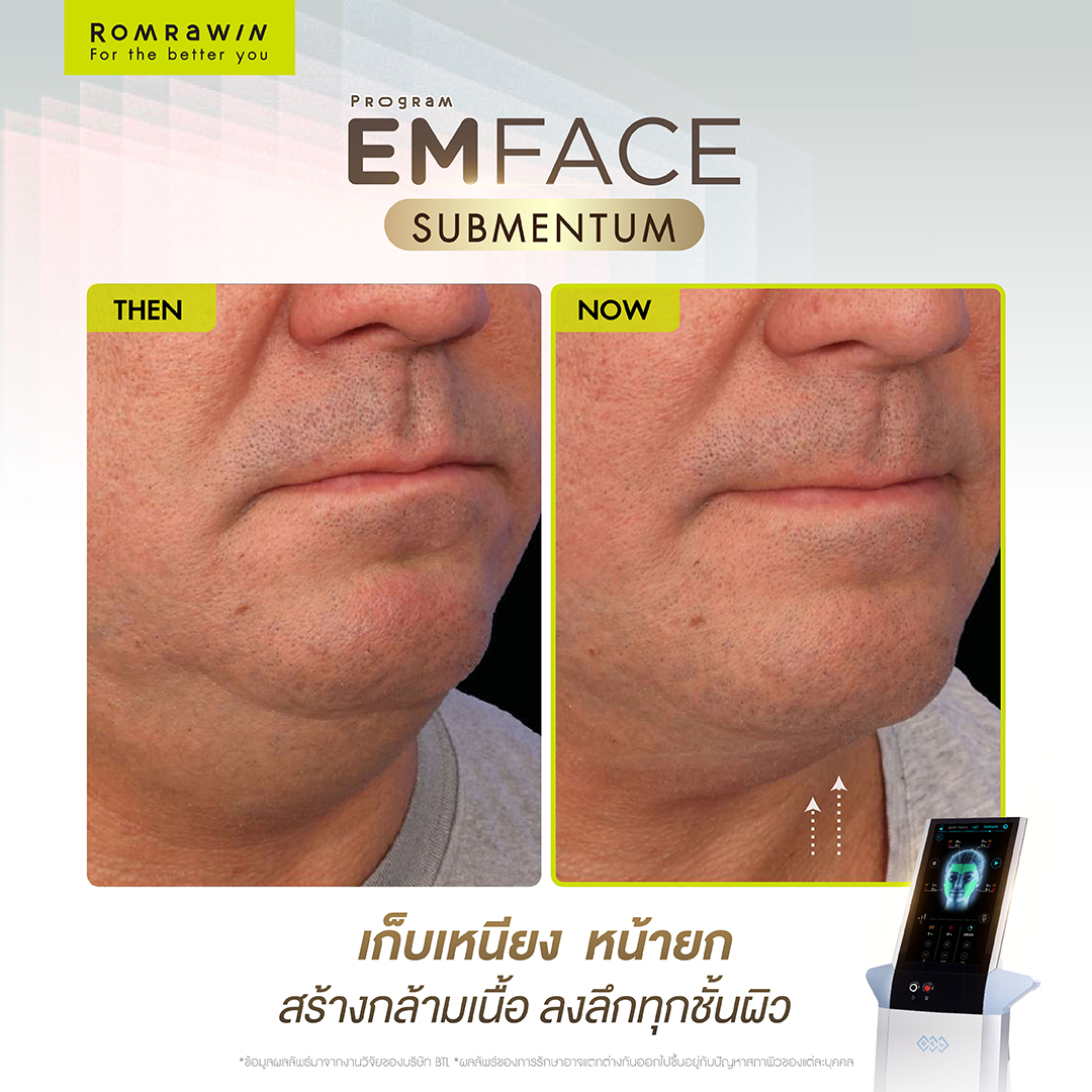 Emface Submentum