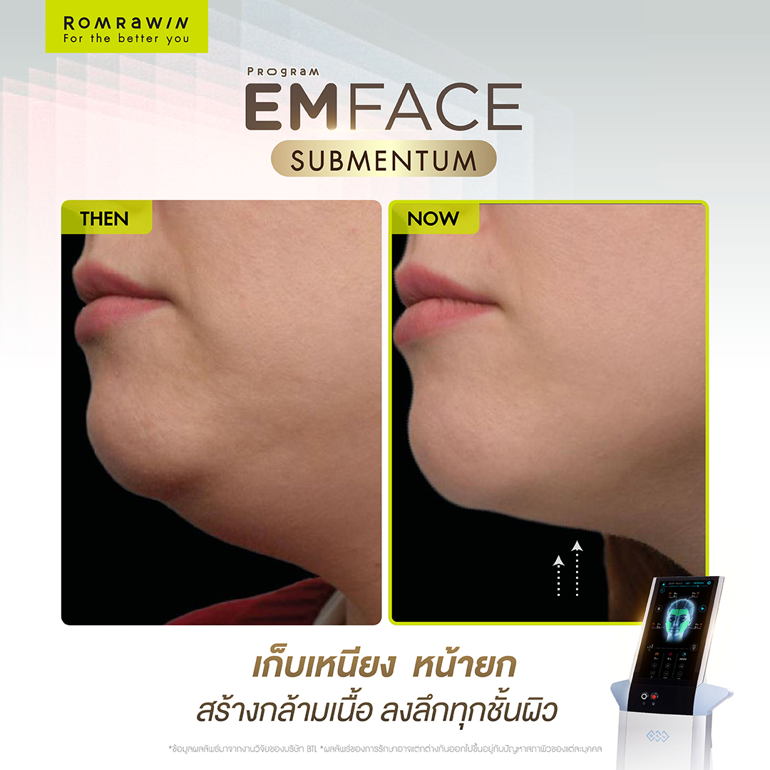 Emface Submentum