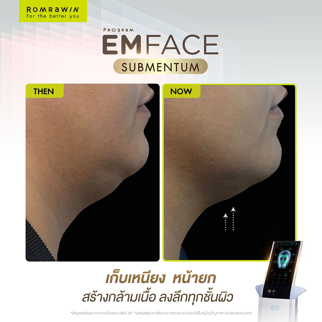 Emface Submentum