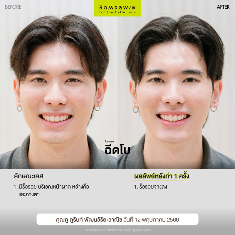 ผลลัพธ์หลังการฉีดโบ