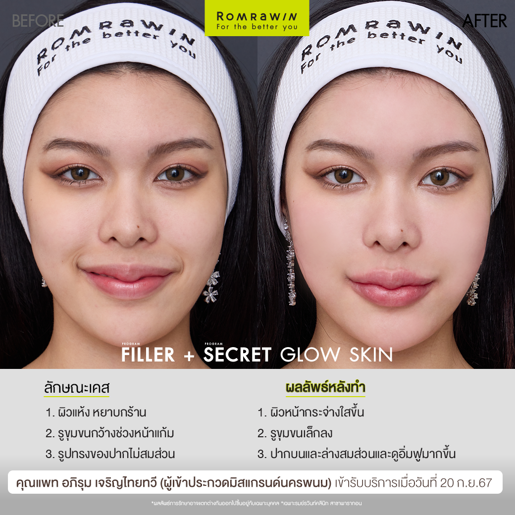 ฟิลเลอร์ปากและ Secret Grow Skin