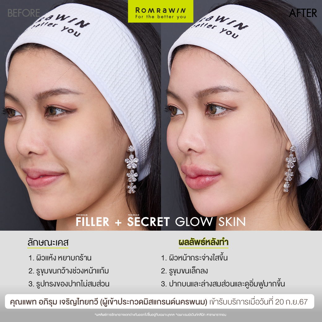 ฟิลเลอร์ปากและ Secret Grow Skin