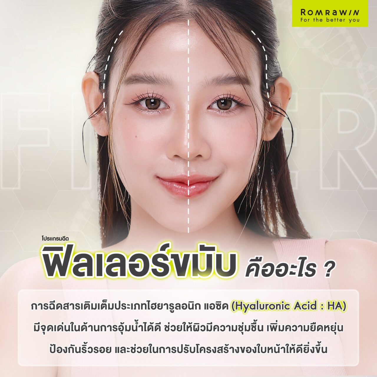 ฟิลเลอร์ขมับ