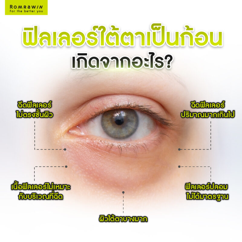 ฟิลเลอร์ใต้ตาเป็นก้อนเกิดจากอะไร