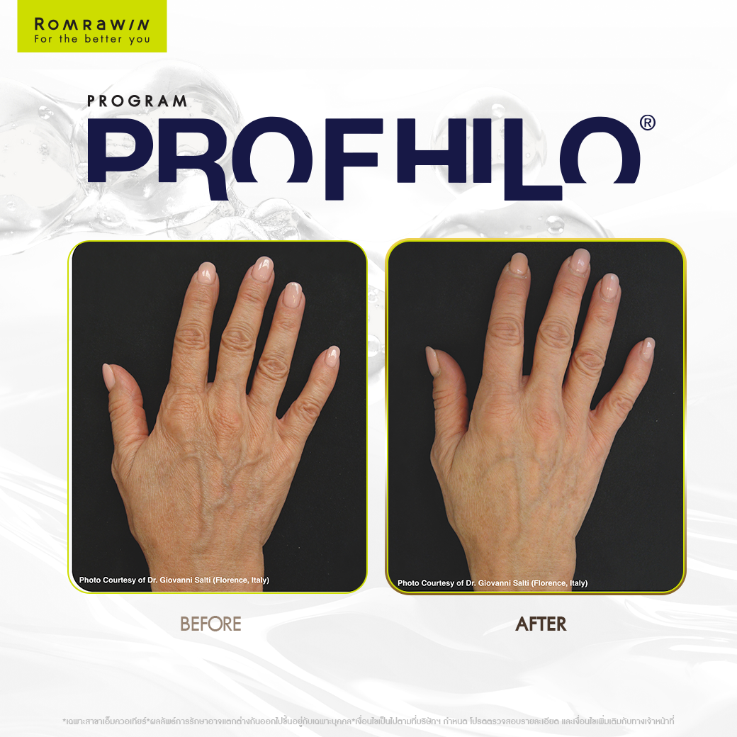 Profhilo