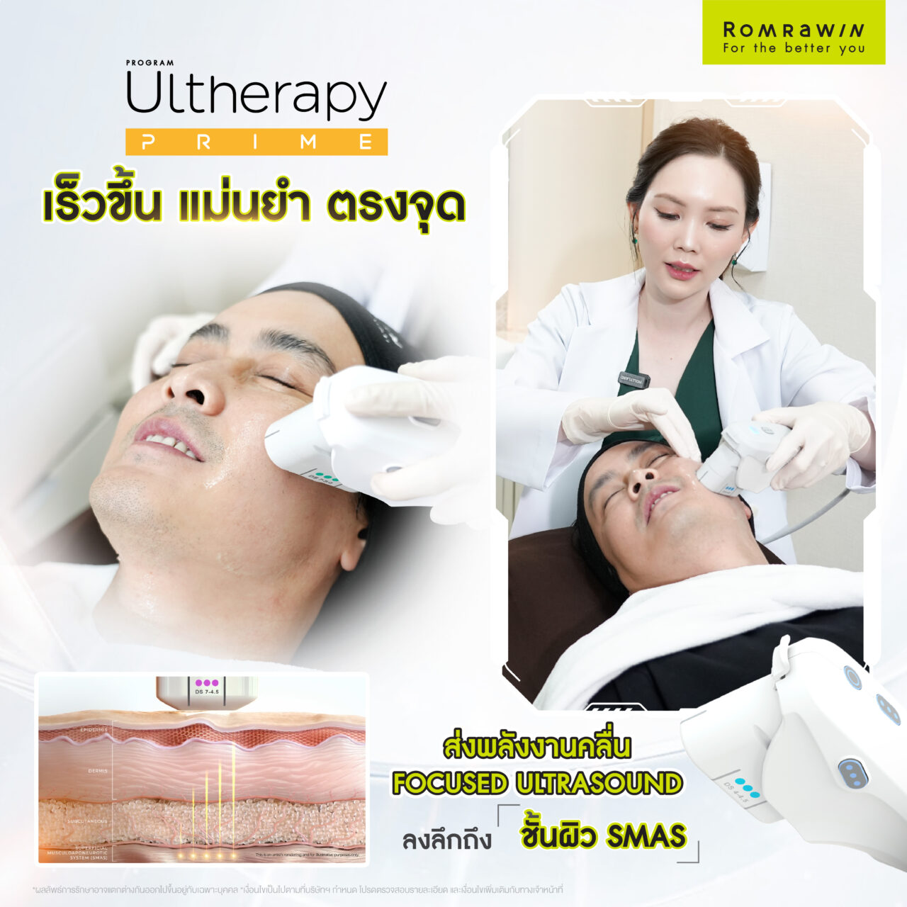 Ultherapy Prime หน้าเด็ก