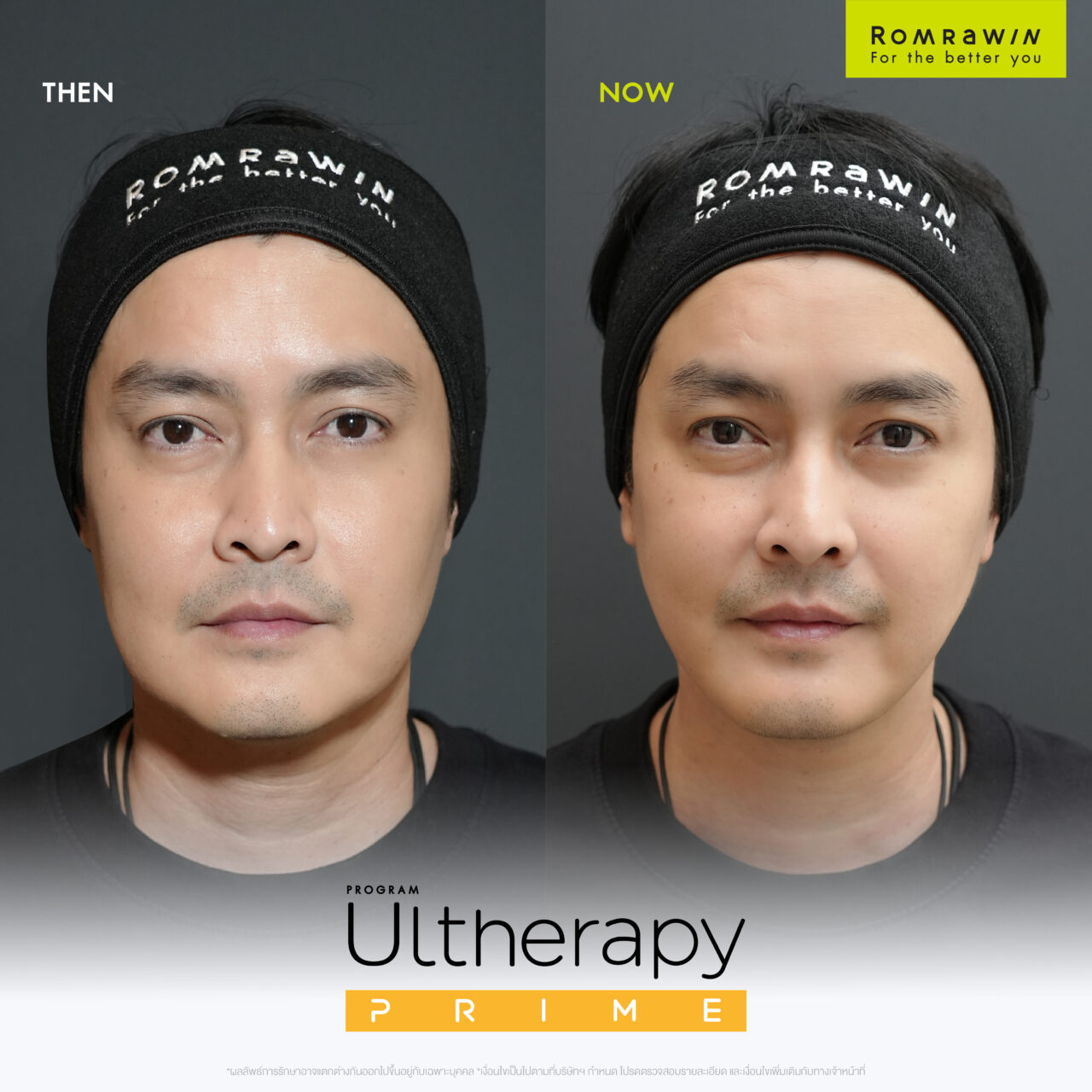 Ultherapy Prime หน้าเด็ก