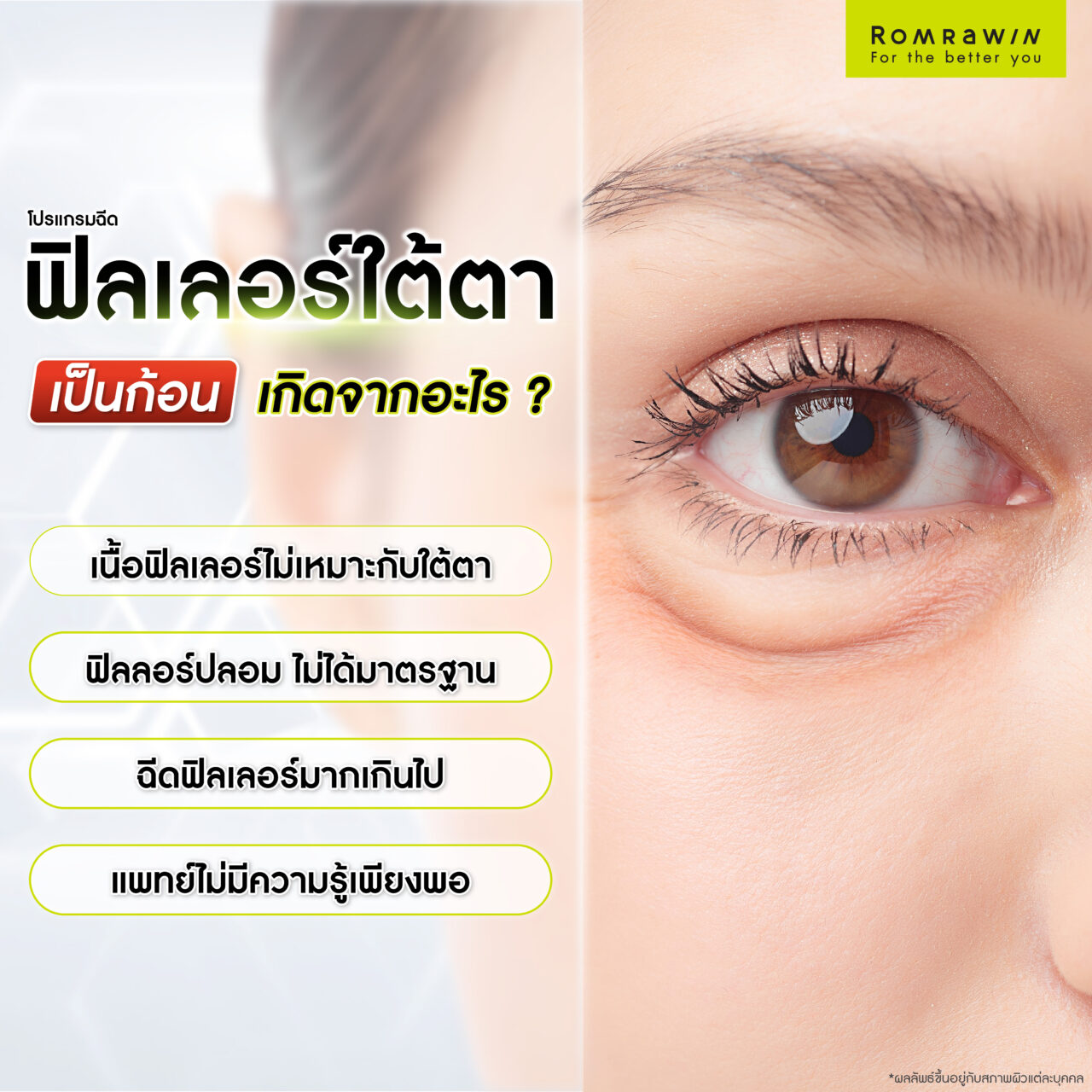 ฟิลเลอร์ใต้ตาเป็นก้อน มีสาเหตุมาจากอะไร?