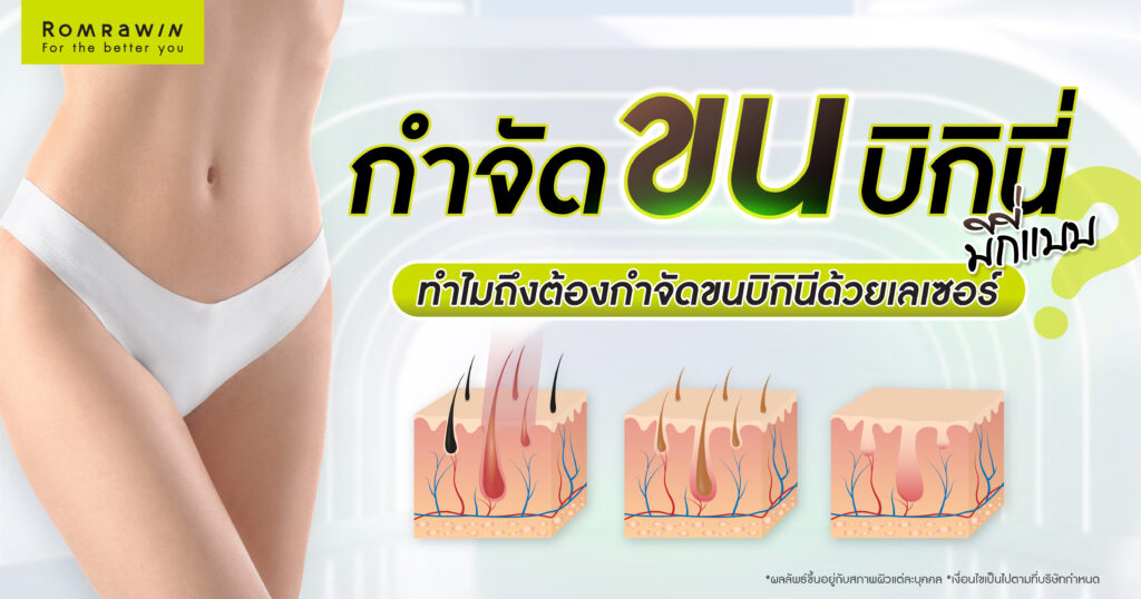 กำจัดขนบิกินี่มีกี่แบบ ? ทำไมถึงต้องกำจัดขนบิกินีด้วยเลเซอร์ 1 กำจัดขนบิกินี่คืออะไร ?