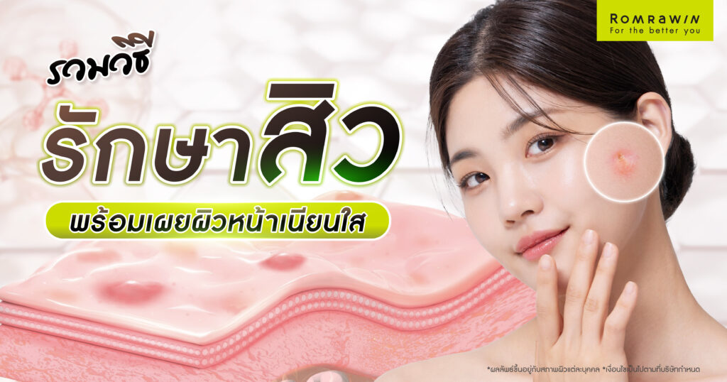 รวมวิธีรักษาสิว พร้อมเผยผิวหน้าเนียนใส