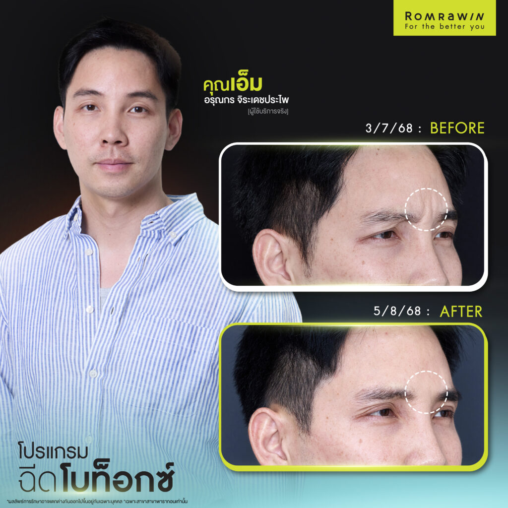 ลดรอยยับย่นด้วยโปรแกรมฉีดโบ คุณเอ็ม อรุณกร