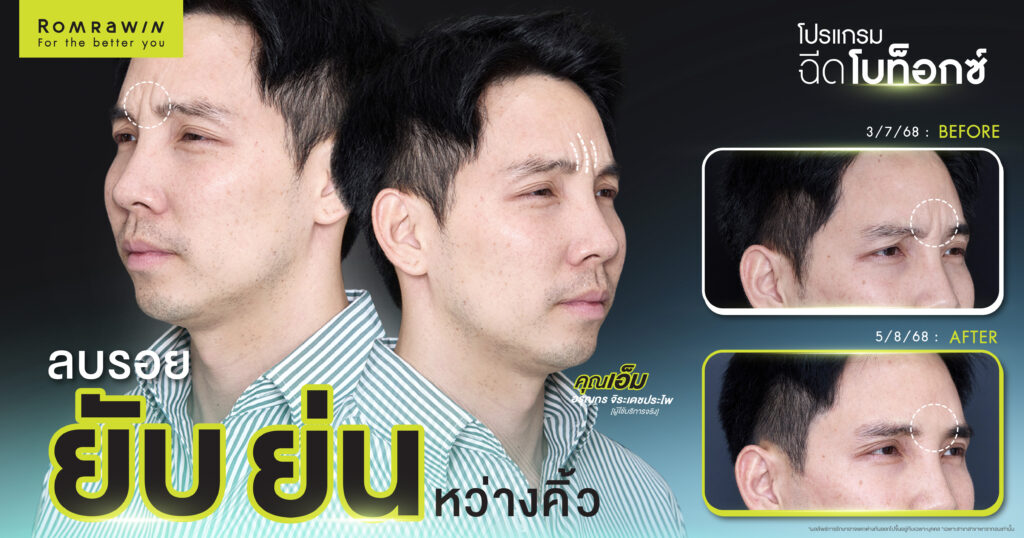 ลดรอยยับย่นด้วยโปรแกรมฉีดโบ คุณเอ็ม อรุณกร