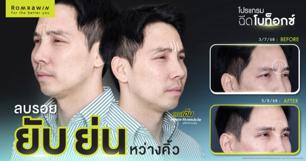 ลดรอยยับย่นด้วยโปรแกรมฉีดโบ คุณเอ็ม อรุณกร