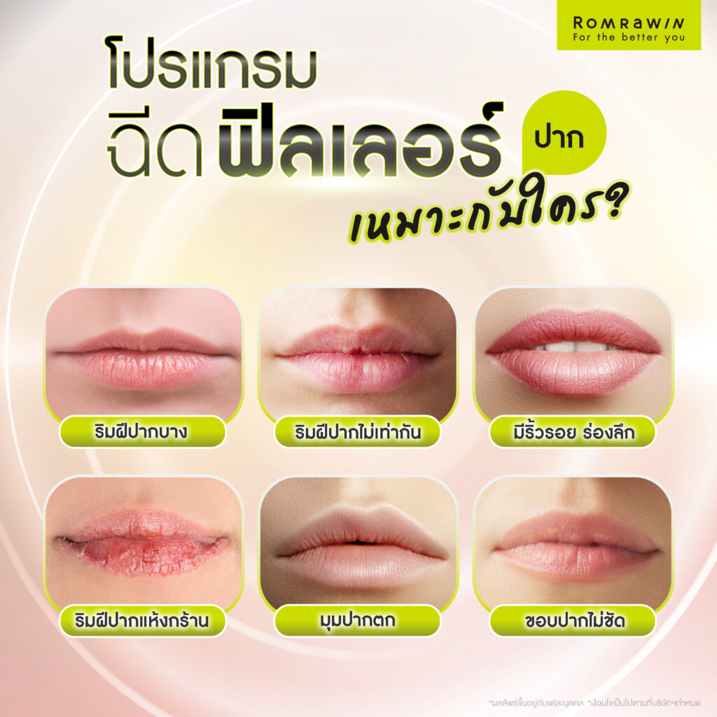 การฉีดฟิลเลอร์ปากเหมาะกับใคร?