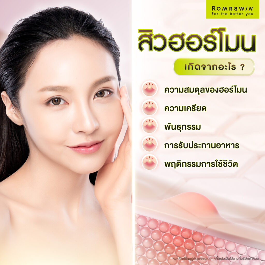 สิวฮอร์โมน เกิดจากอะไร ?