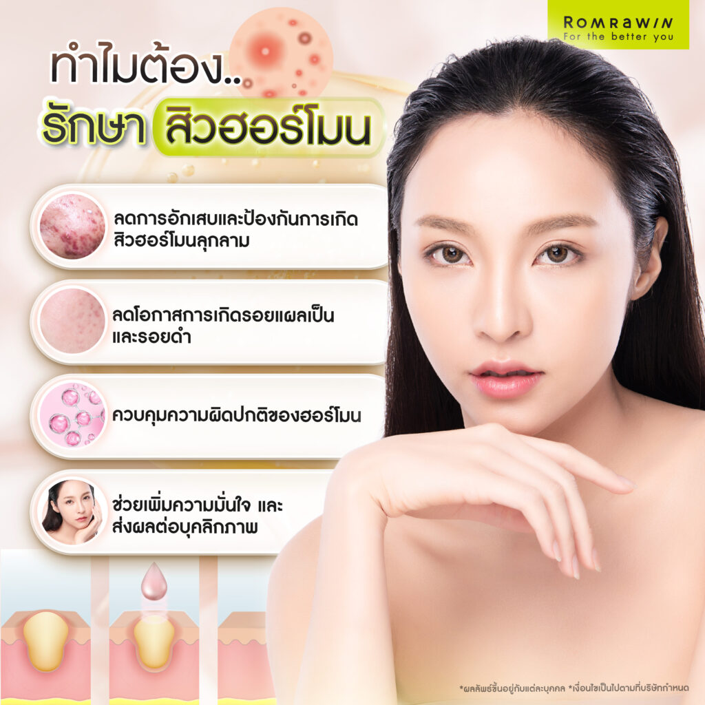 ทำไมต้องรักษาสิวฮอร์โมน