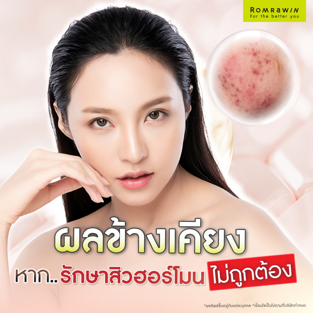 ผลข้างเคียงที่อาจเกิดได้หากรักษาสิวฮอร์โมนไม่ถูกต้อง