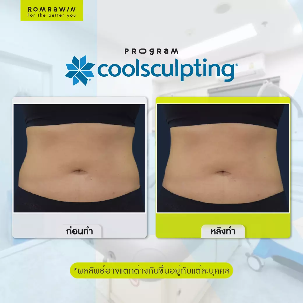 Coolsculpting