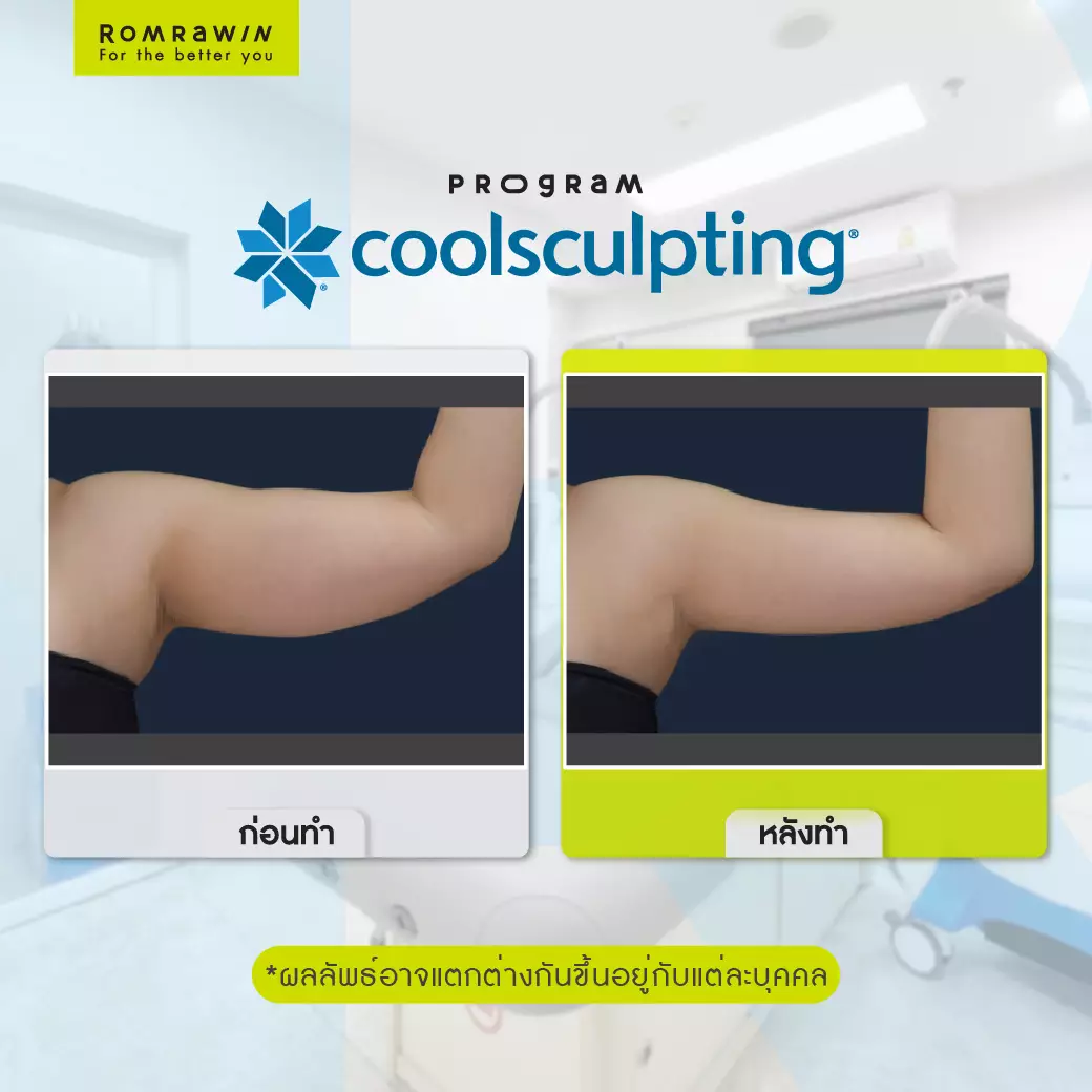 Coolsculpting