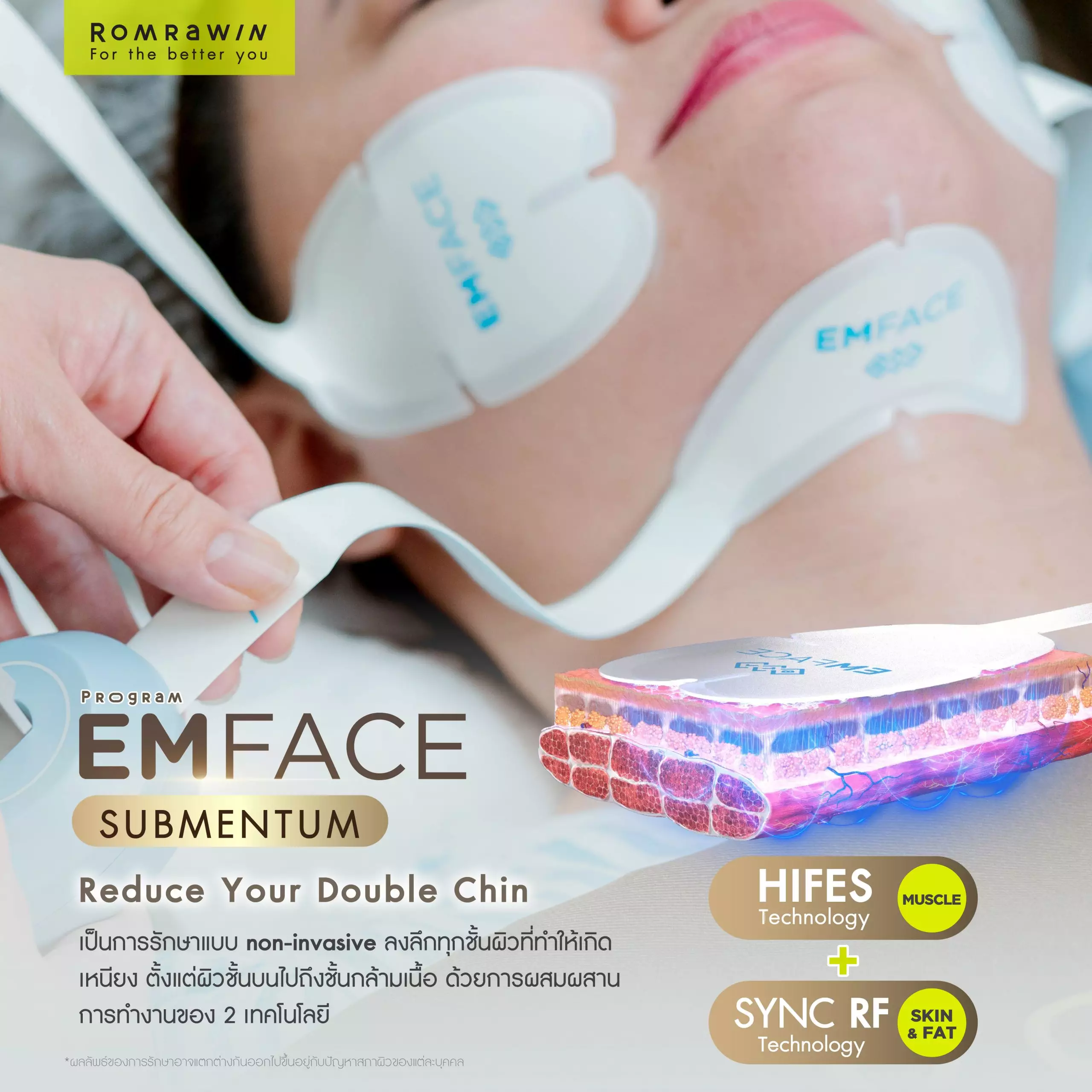 Emface Submentum