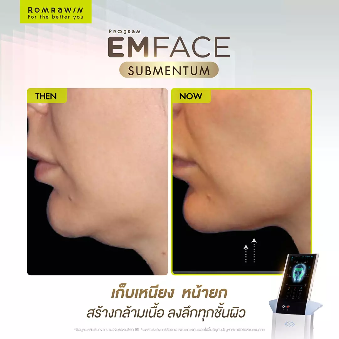 Emface Submentum