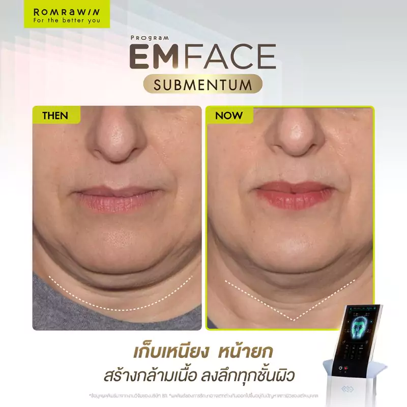 Emface Submentum เก็บเหนียง หน้ายก คืออะไร? เหมาะกับใคร ? 3 Emface Submentum