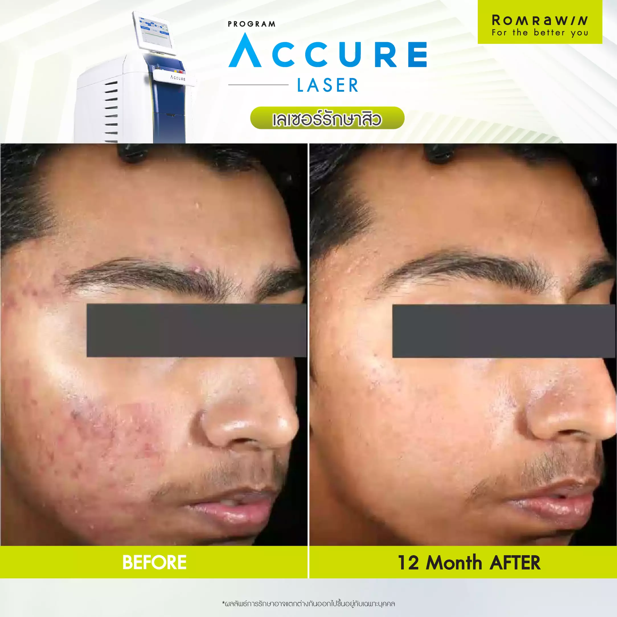 Accure Laser