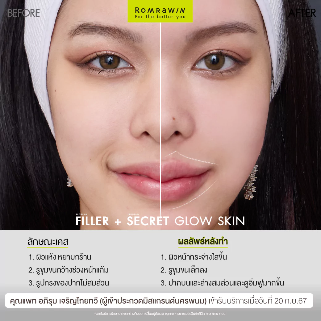 ฟิลเลอร์ปากและ Secret Grow Skin