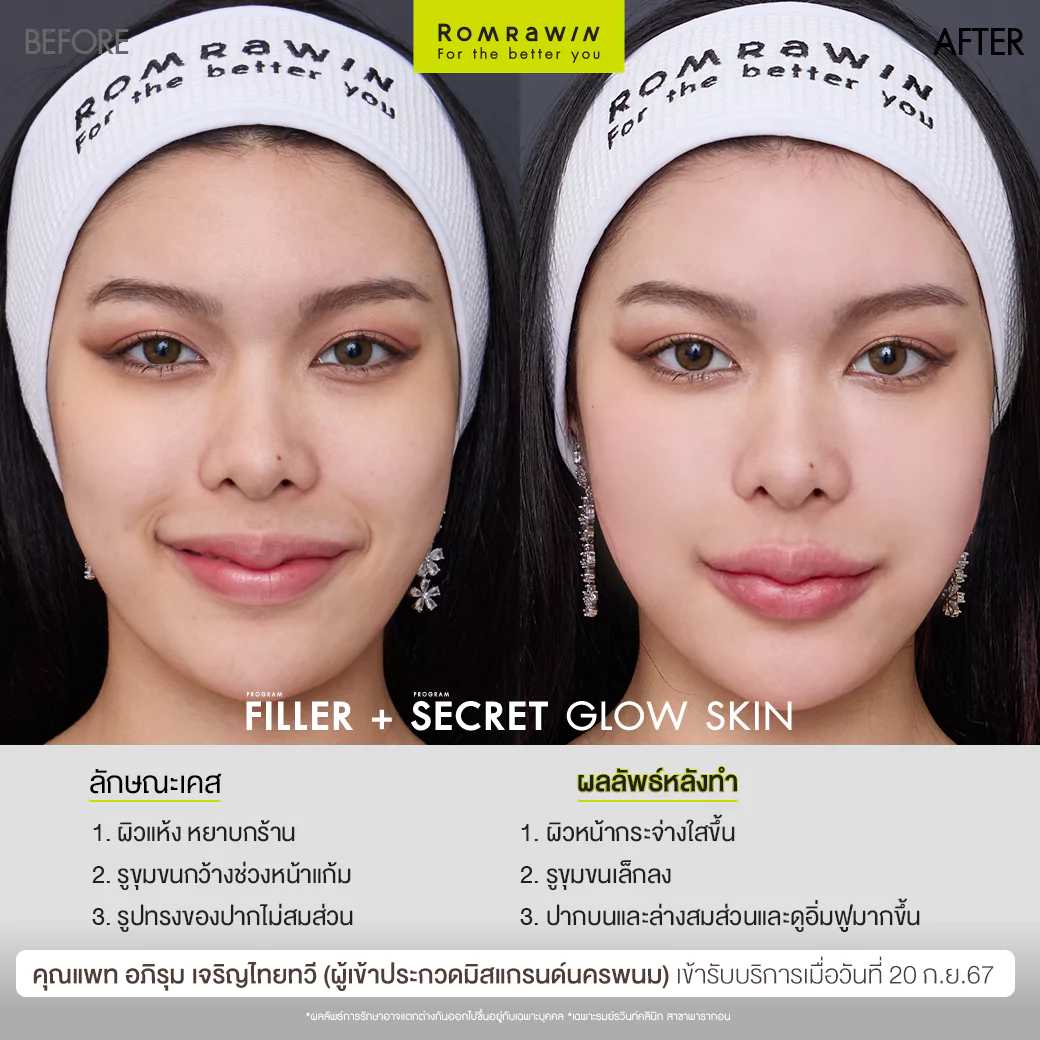 ฟิลเลอร์ปากและ Secret Grow Skin