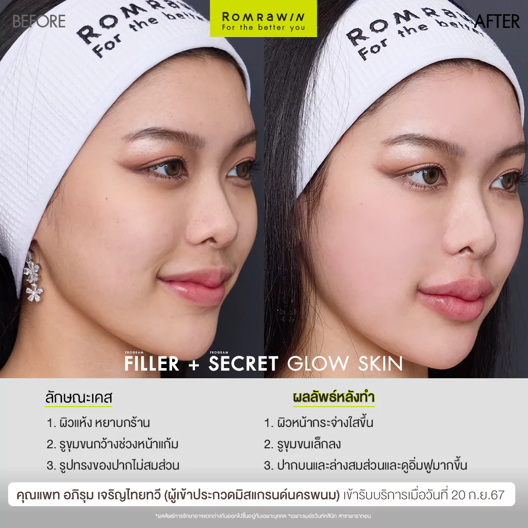 ฟิลเลอร์ปากและ Secret Grow Skin