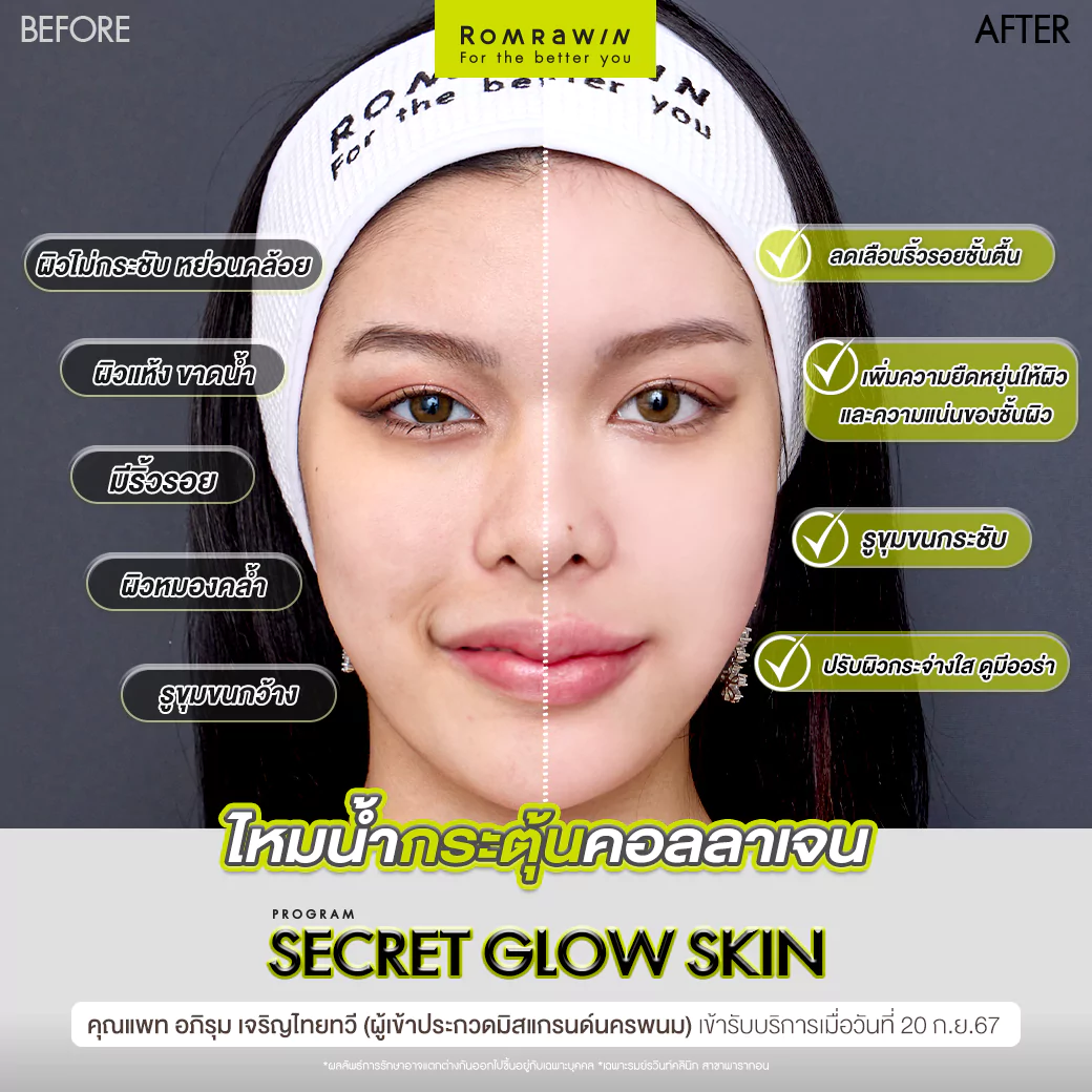 ฟิลเลอร์ปากและ Secret Grow Skin