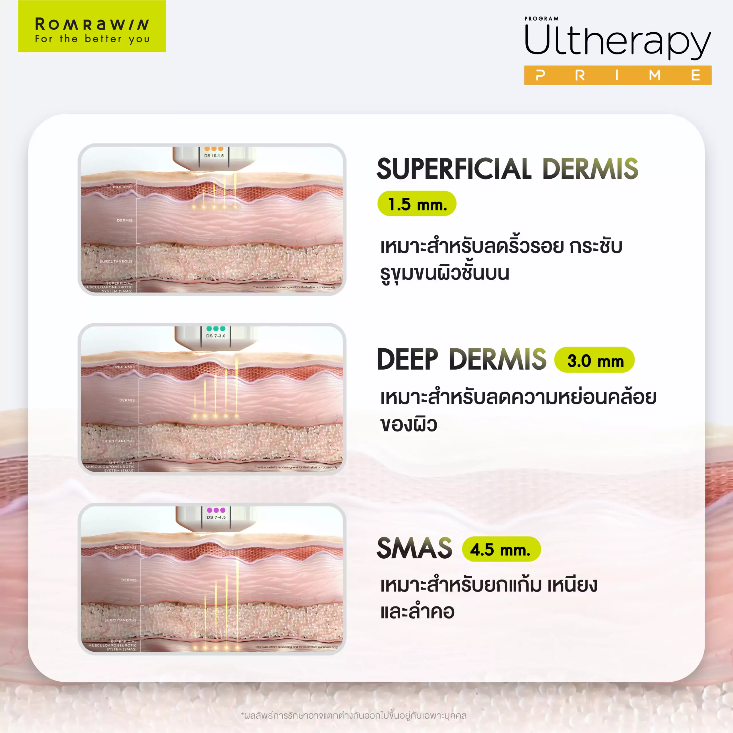 ULTHERAPY PRIME