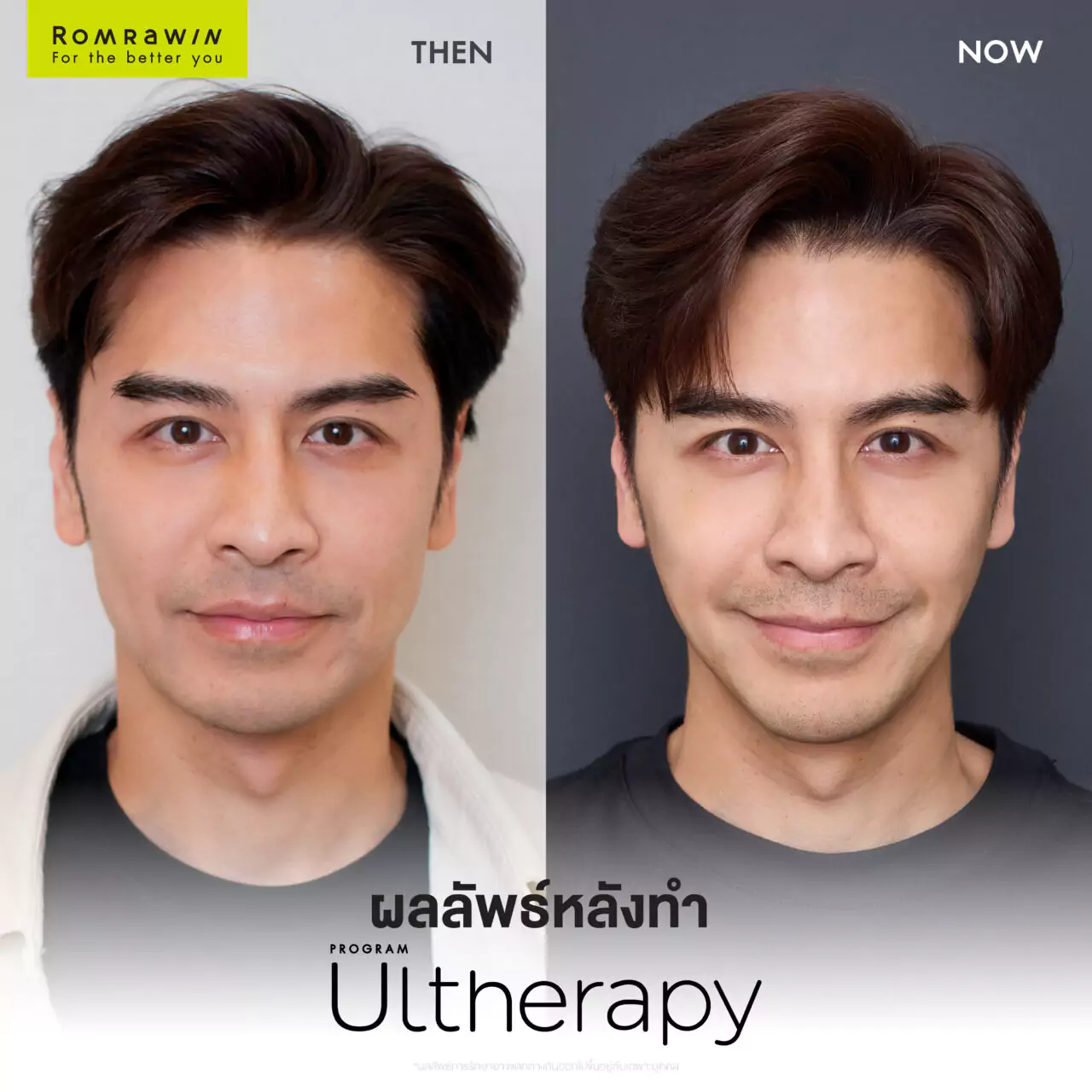 06 11 67 Ultherapy 03