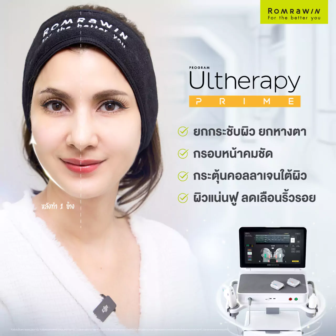 Ultherapy Prime