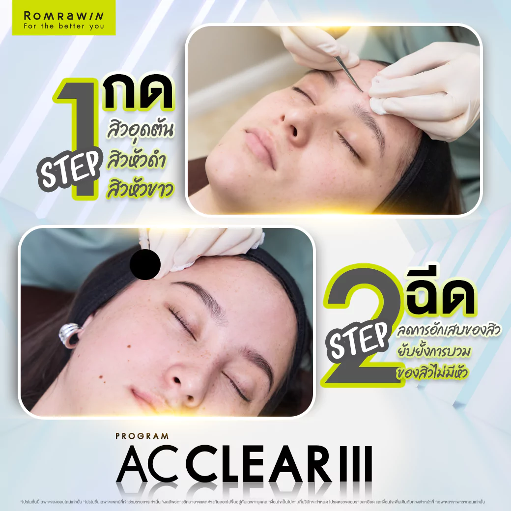 AC CLEAR III รีวิว