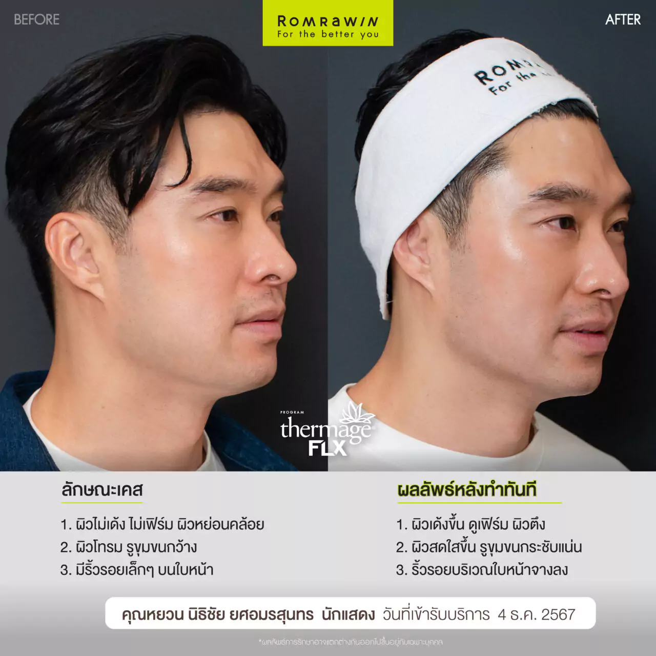 Thermage FLX ยกหน้าตึง