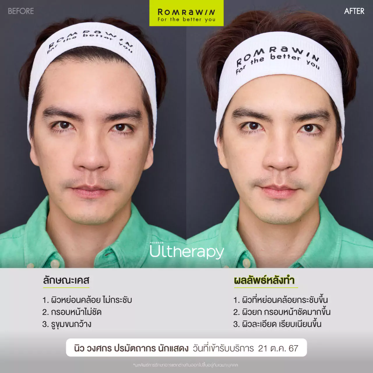 ultherapy ยกกระชับ