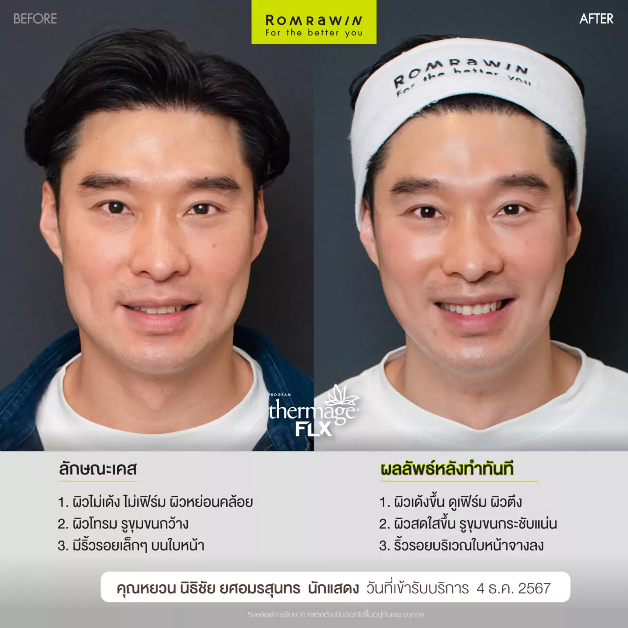 Thermage FLX ยกหน้าตึง