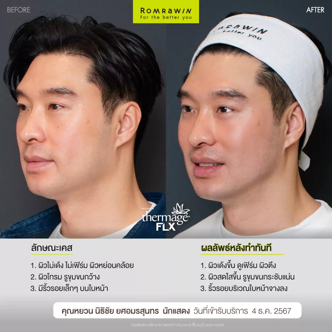 Thermage FLX ยกหน้าตึง