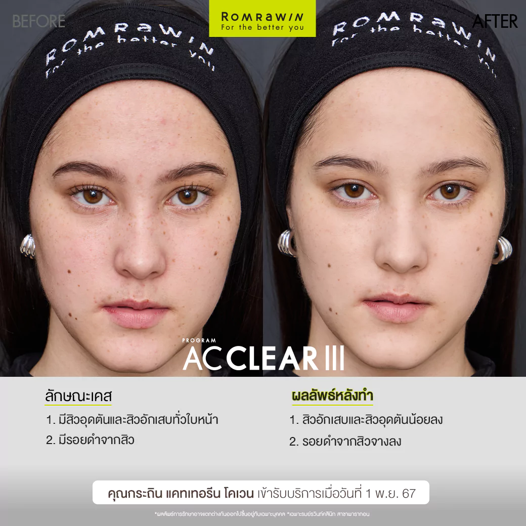 คุณกระถิน AC CLEAR III