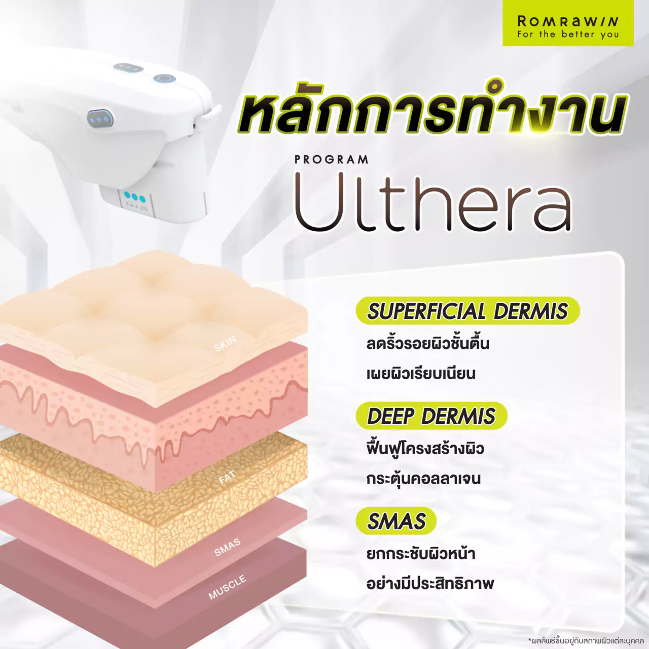 หลักการทำงานของ ULTHERA