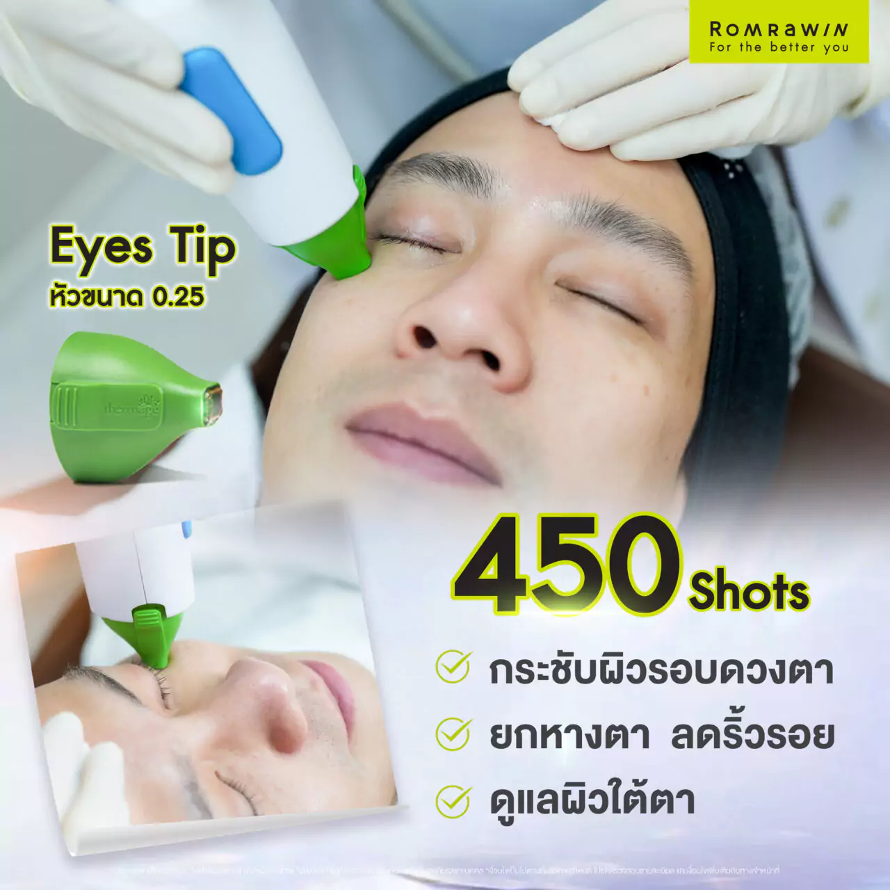  Thermage FLX ผลลัพธ์ขึ้นอยู่กับบุคคล