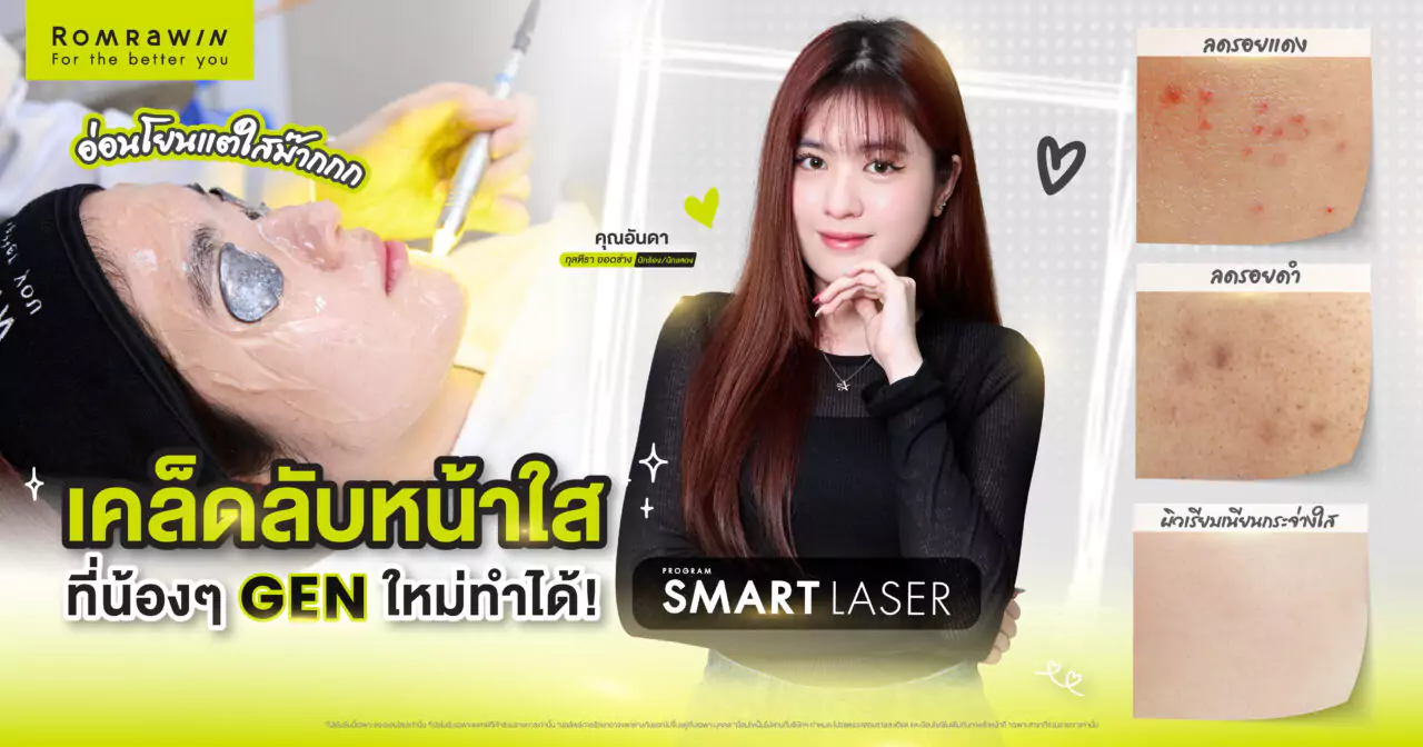 Smart Laser ลดรอยสิว