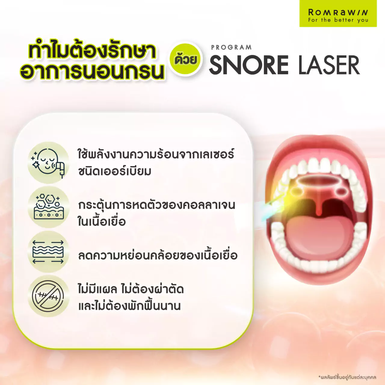 สาเหตุของการนอนกรน : ทำไมต้องรักษานอนกรนด้วยโปรแกรม Snore Laser