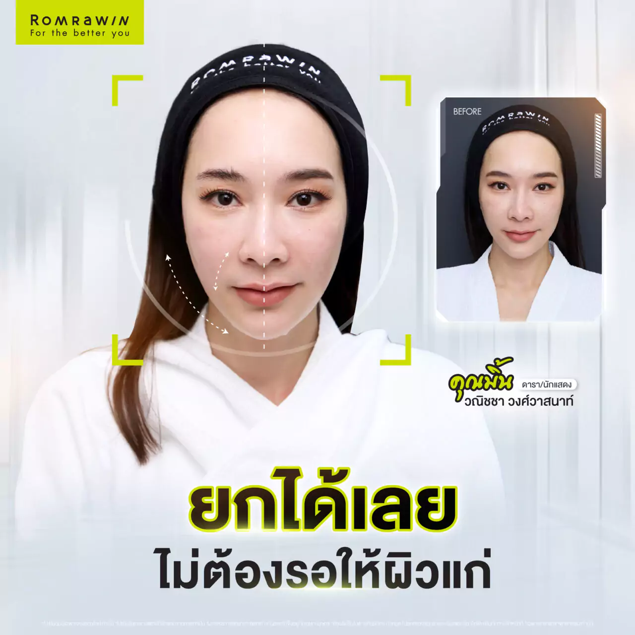 มิ้นท์ ณัฐวรา โปรแกรม Ultherapy Prime