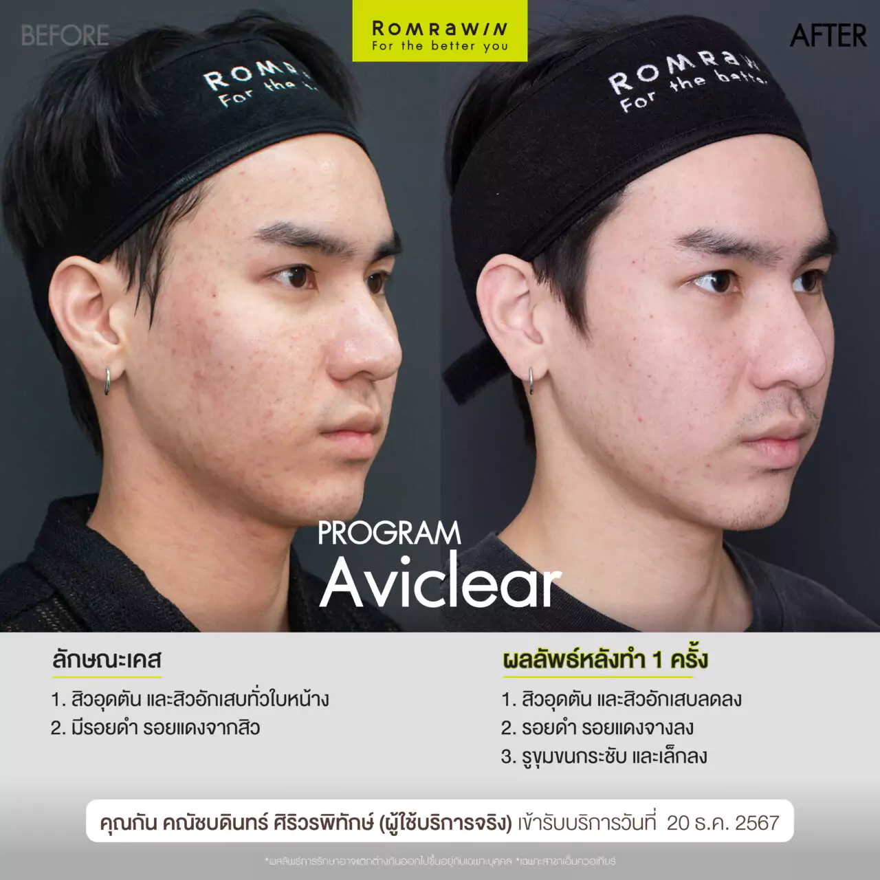 สิวหยุดขึ้นไม่ต้องพึ่งยาด้วย Aviclear  